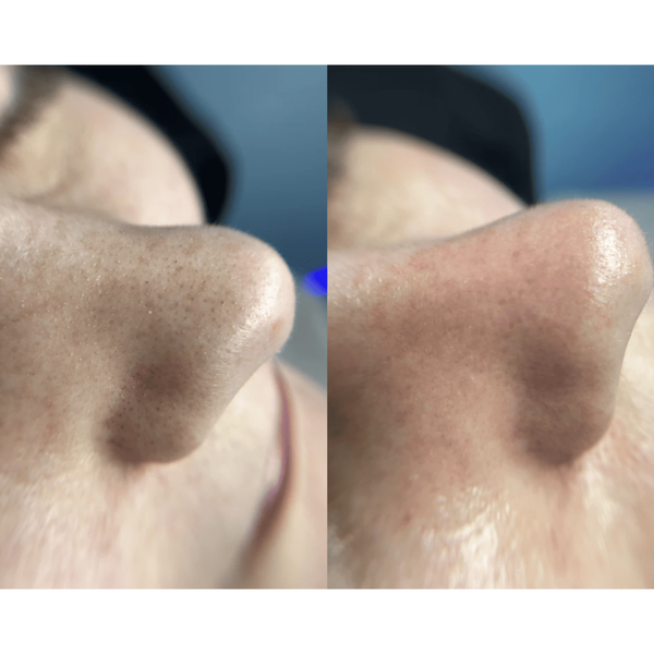 Ультразвуковой скраббер для кожи лица MEDICA+ Vibroskin 8.0 (Japan) MEDICA+50124 фото