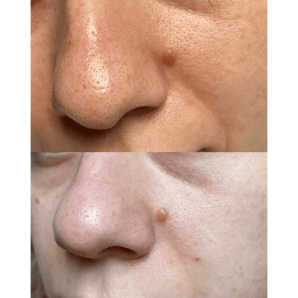 Ультразвуковой скраббер для кожи лица MEDICA+ Vibroskin 5.0 (Japan) MEDICA+50122 фото